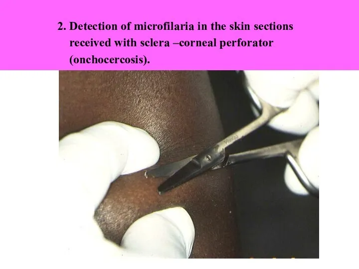 2. Detection of microfilaria in the skin sections received with sclera –corneal perforator (onchocercosis).