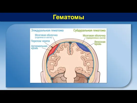 Гематомы