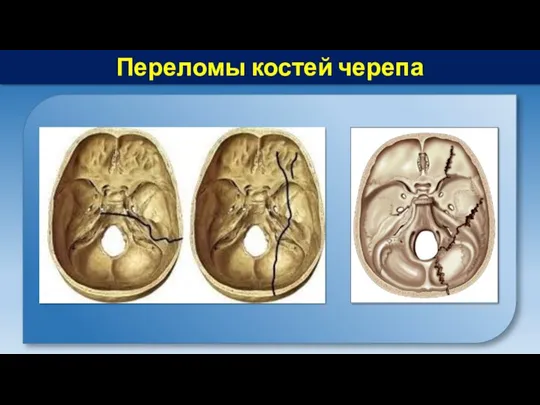 Переломы костей черепа