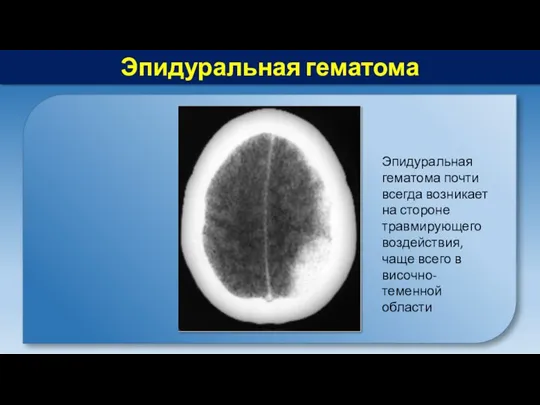 Эпидуральная гематома Эпидуральная гематома почти всегда возникает на стороне травмирующего воздействия, чаще всего в височно-теменной области