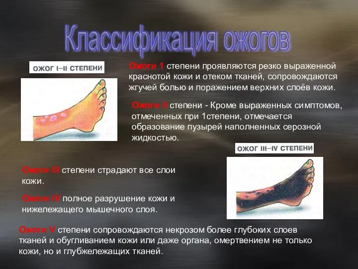 Ожоги 1 степени проявляются резко выраженной краснотой кожи и отеком тканей, сопровождаются