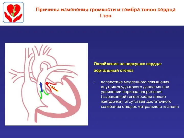 Причины изменения громкости и тембра тонов сердца I тон Ослабление на верхушке