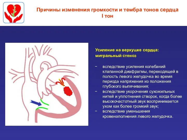 Причины изменения громкости и тембра тонов сердца I тон Усиление на верхушке