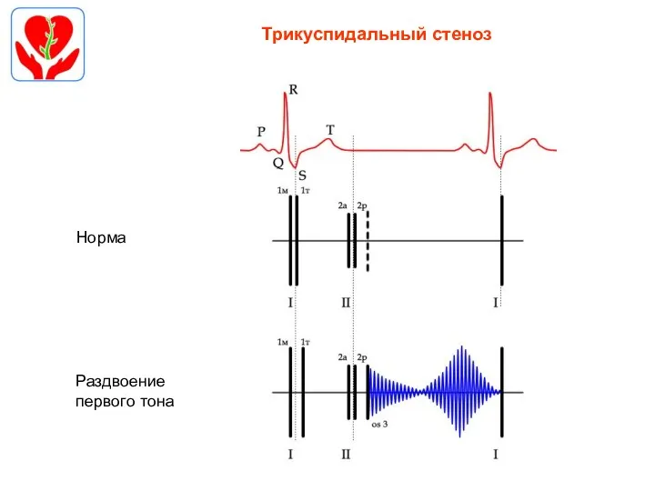 Трикуспидальный стеноз Норма Раздвоение первого тона