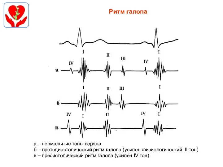 Ритм галопа а – нормальные тоны сердца б – протодиастолический ритм галопа