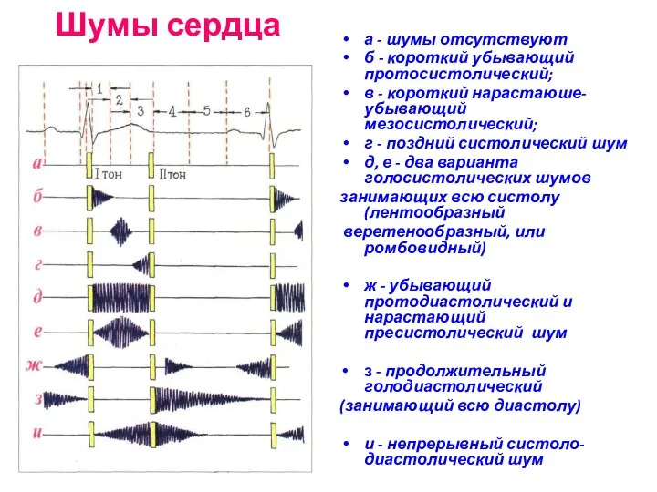 Шумы сердца а - шумы отсутствуют б - короткий убывающий протосистолический; в