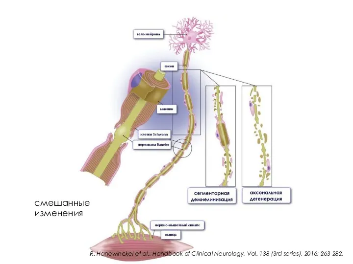 смешанные изменения R. Hanewinckel et al., Handbook of Clinical Neurology, Vol. 138 (3rd series), 2016: 263-282.