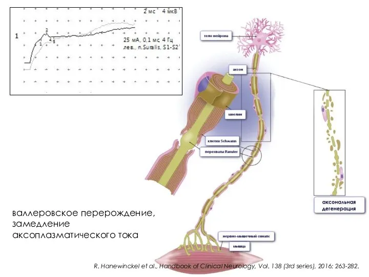 валлеровское перерождение, замедление аксоплазматического тока R. Hanewinckel et al., Handbook of Clinical