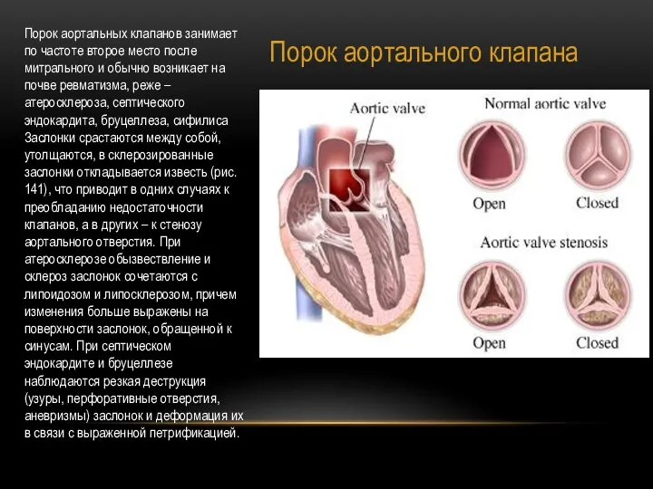 Порок аортального клапана Порок аортальных клапанов занимает по частоте второе место после