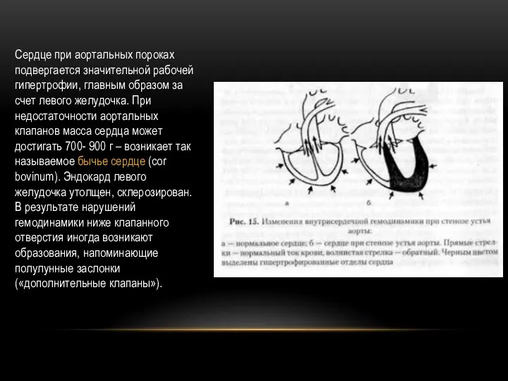 Сердце при аортальных пороках подвергается значительной рабочей гипертрофии, главным образом за счет