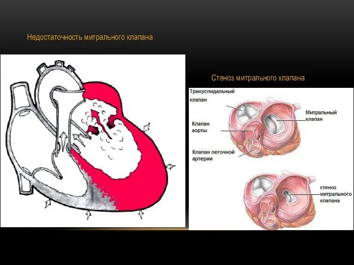 Недостаточность митрального клапана Стеноз митрального клапана