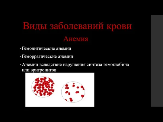 Виды заболеваний крови Анемия Гемолитические анемии Геморрагические анемии Анемии вследствие нарушения синтеза гемоглобина или эритроцитов
