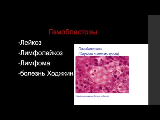 Гемобластозы Лейкоз Лимфолейкоз Лимфома болезнь Ходжкина