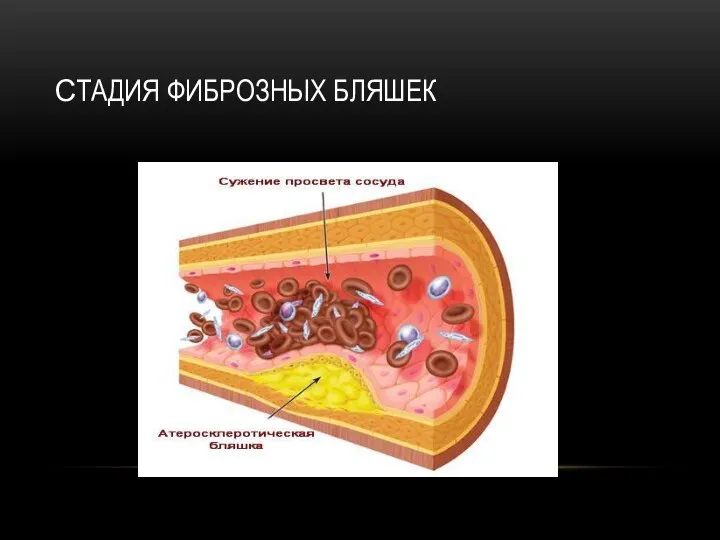 СТАДИЯ ФИБРОЗНЫХ БЛЯШЕК