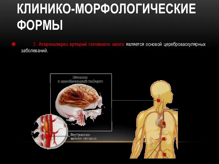 КЛИНИКО-МОРФОЛОГИЧЕСКИЕ ФОРМЫ 3. Атеросклероз артерий головного мозга является основой цереброваскулярных заболеваний.
