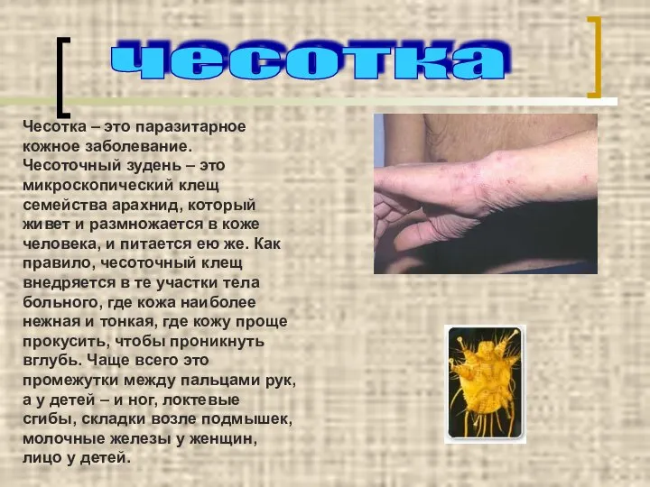 чесотка Чесотка – это паразитарное кожное заболевание. Чесоточный зудень – это микроскопический