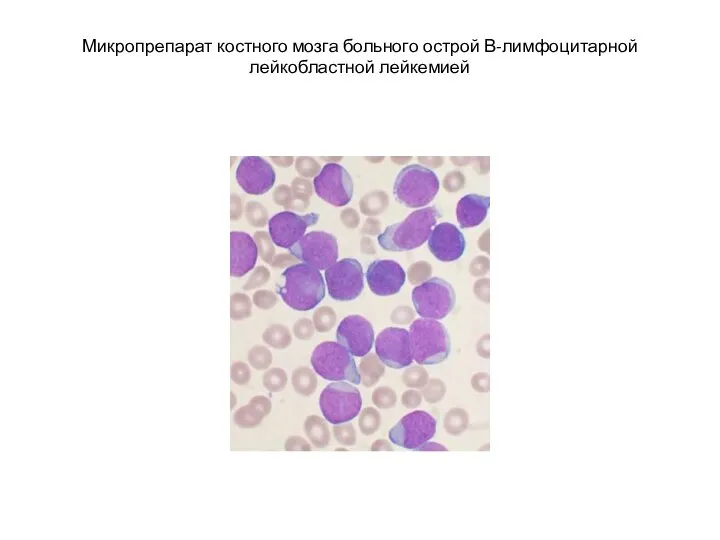 Микропрепарат костного мозга больного острой В-лимфоцитарной лейкобластной лейкемией