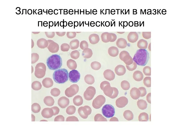 Злокачественные клетки в мазке периферической крови