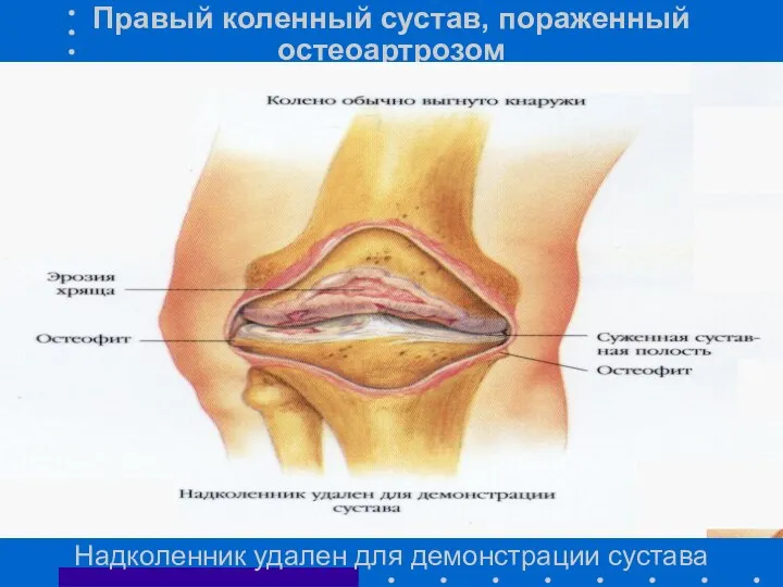Правый коленный сустав, пораженный остеоартрозом Надколенник удален для демонстрации сустава