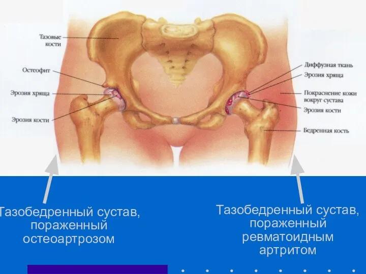 Тазобедренный сустав, пораженный остеоартрозом Тазобедренный сустав, пораженный ревматоидным артритом