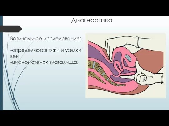 Диагностика Вагинальное исследование: -определяются тяжи и узелки вен -цианоз стенок влагалища.