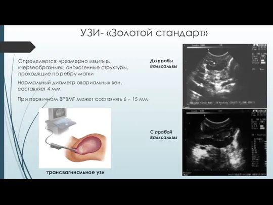 УЗИ- «Золотой стандарт» Определяются: чрезмерно извитые, «червеобразные», анэхогенные структуры, проходящие по ребру