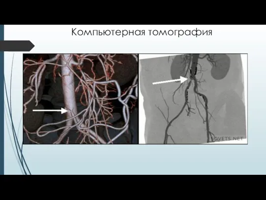 Компьютерная томография