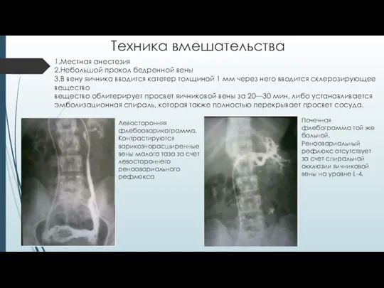 Техника вмешательства 1.Местная анестезия 2.Небольшой прокол бедренной вены 3.В вену яичника вводится