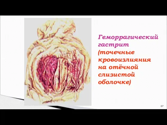 Геморрагический гастрит (точечные кровоизлияния на отёчной слизистой оболочке)