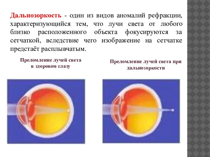 Преломление лучей света в здоровом глазу Преломление лучей света при дальнозоркости Дальнозоркость