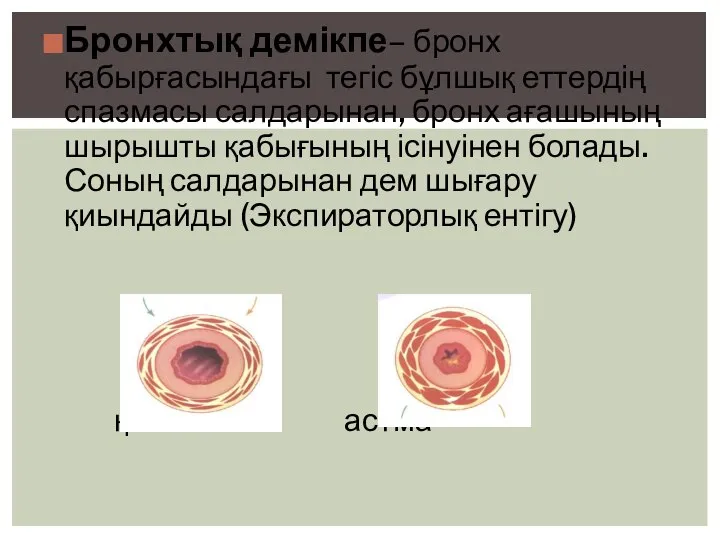 Бронхтық демікпе– бронх қабырғасындағы тегіс бұлшық еттердің спазмасы салдарынан, бронх ағашының шырышты