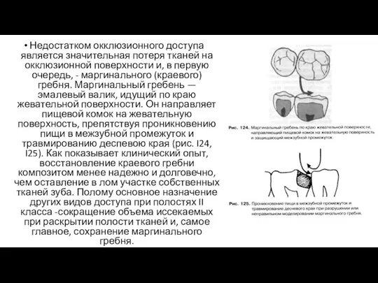 Недостатком окклюзионного доступа является значительная потеря тканей на окклюзионной поверхности и, в