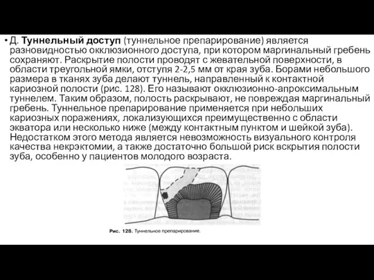 Д. Туннельный доступ (туннельное препарирование) является разновидностью окклюзионного доступа, при котором маргинальный