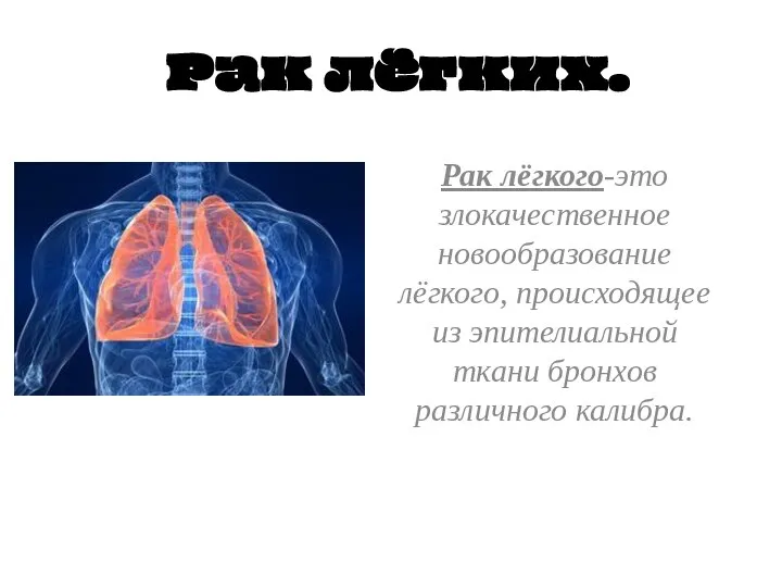 Рак лёгких. Рак лёгкого-это злокачественное новообразование лёгкого, происходящее из эпителиальной ткани бронхов различного калибра.