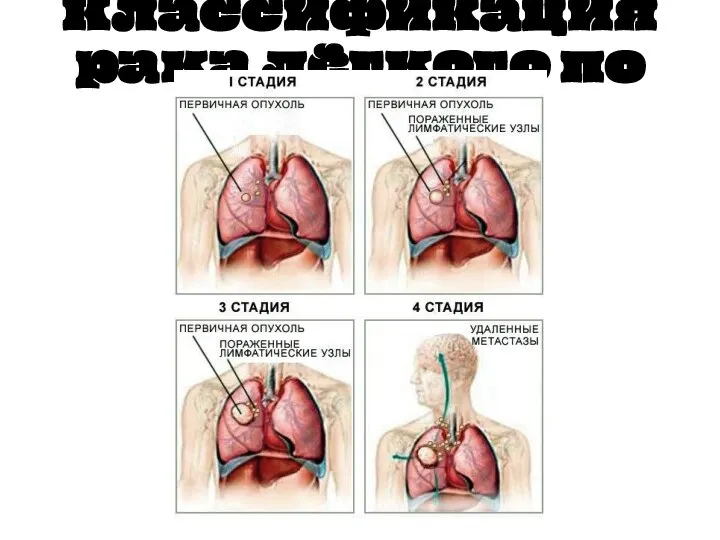 Классификация рака лёгкого по стадиям