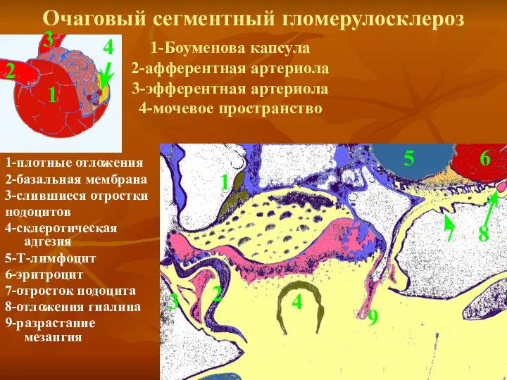 Очаговый сегментный гломерулосклероз 1-плотные отложения 2-базальная мембрана 3-слившиеся отростки подоцитов 4-склеротическая адгезия