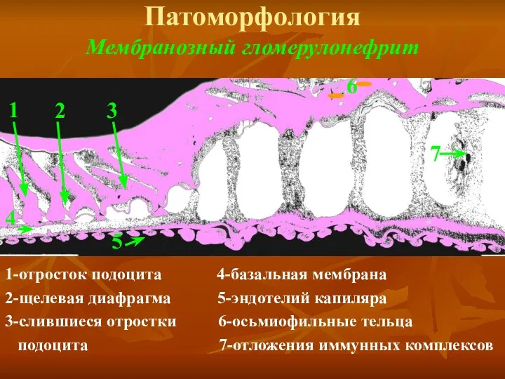 Патоморфология Мембранозный гломерулонефрит 1-отросток подоцита 4-базальная мембрана 2-щелевая диафрагма 5-эндотелий капиляра 3-слившиеся