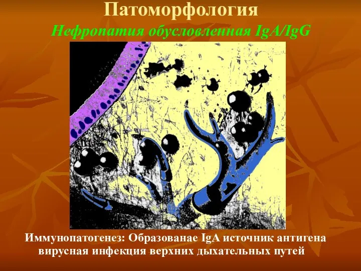 Патоморфология Нефропатия обусловленная IgA/IgG Иммунопатогенез: Образованае IgA источник антигена вирусная инфекция верхних дыхательных путей
