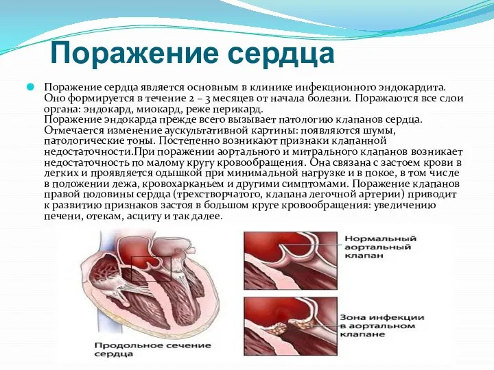Поражение сердца Поражение сердца является основным в клинике инфекционного эндокардита. Оно формируется