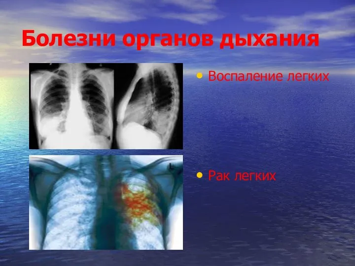 Болезни органов дыхания Воспаление легких Рак легких