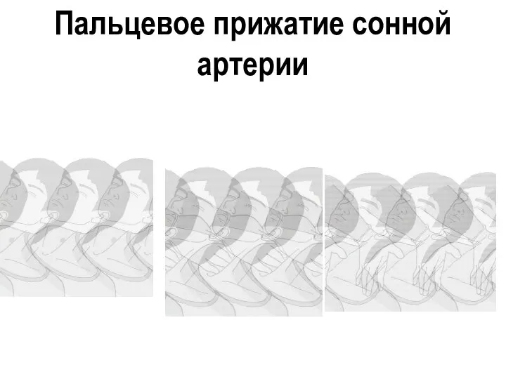 Пальцевое прижатие сонной артерии