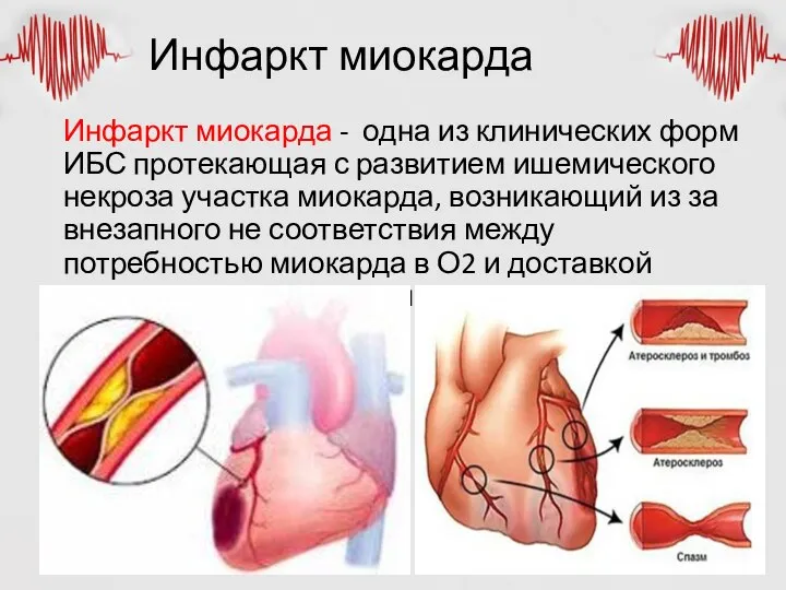 Инфаркт миокарда Инфаркт миокарда - одна из клинических форм ИБС протекающая с