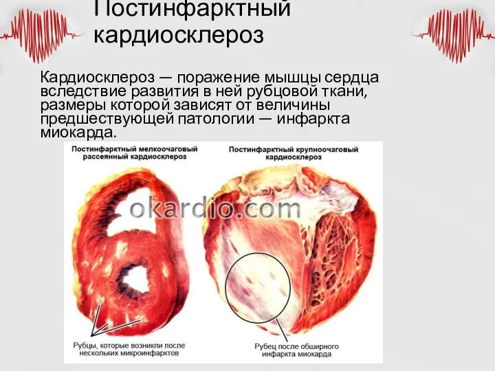 Постинфарктный кардиосклероз Кардиосклероз — поражение мышцы сердца вследствие развития в ней рубцовой