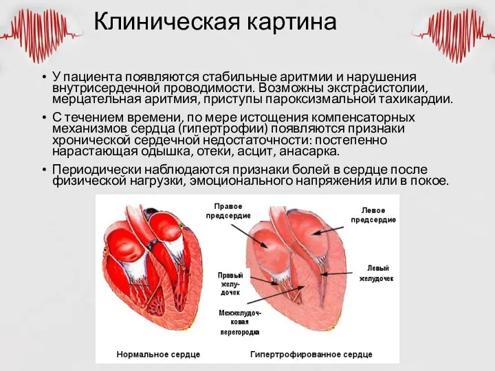 Клиническая картина У пациента появляются стабильные аритмии и нарушения внутрисердечной проводимости. Возможны