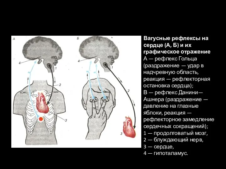 Вагусные рефлексы на сердце (А, Б) и их графическое отражение А —