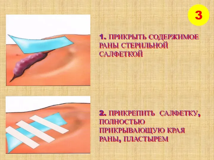 3 1. ПРИКРЫТЬ СОДЕРЖИМОЕ РАНЫ СТЕРИЛЬНОЙ САЛФЕТКОЙ 2. ПРИКРЕПИТЬ САЛФЕТКУ, ПОЛНОСТЬЮ ПРИКРЫВАЮЩУЮ КРАЯ РАНЫ, ПЛАСТЫРЕМ