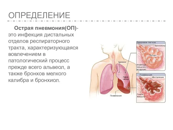 ОПРЕДЕЛЕНИЕ Острая пневмония(ОП)- это инфекция дистальных отделов респираторного тракта, характеризующаяся вовлечением в