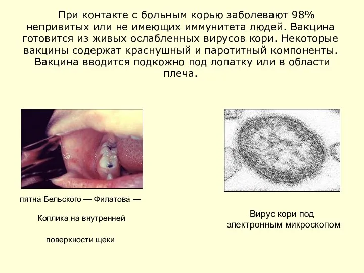 пятна Бельского — Филатова — Коплика на внутренней поверхности щеки При контакте