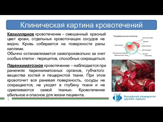 Клиническая картина кровотечений Капиллярное кровотечение – смешанный красный цвет крови, отдельных кровоточащих