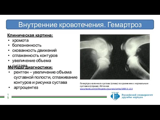 Внутренние кровотечения. Гемартроз Клиническая картина: хромота болезненность скованность движений сглаженность контуров увеличение